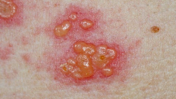 Shingles rash early blisters if know herpes case do