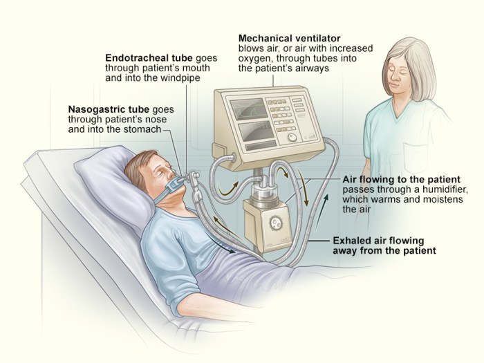 Ventilation mcanique par insufflation