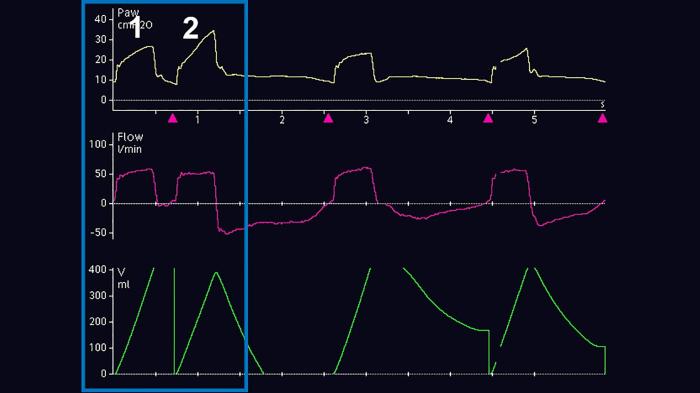 Ventilator